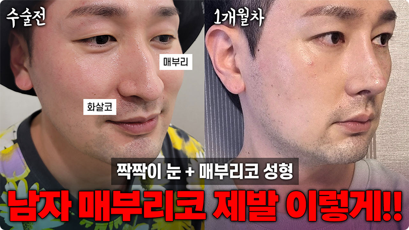 역대급 매부리코 성형... 어떻게 했지? #코성형 #눈성형 #매부리코