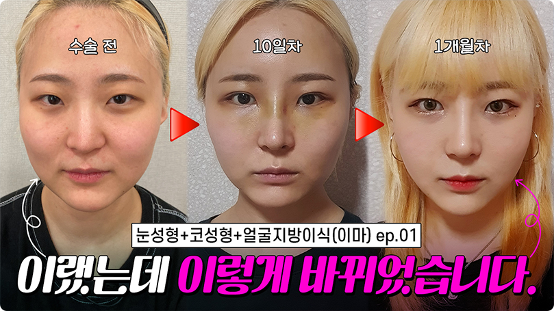 쌍꺼풀이 있었는데...? 매부리 화살코의 대변화 #매부리 #코성형 #비절개눈매교정