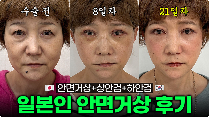 한국에서 안면거상 했어요✈️ ｜ 일본인 성형후기
