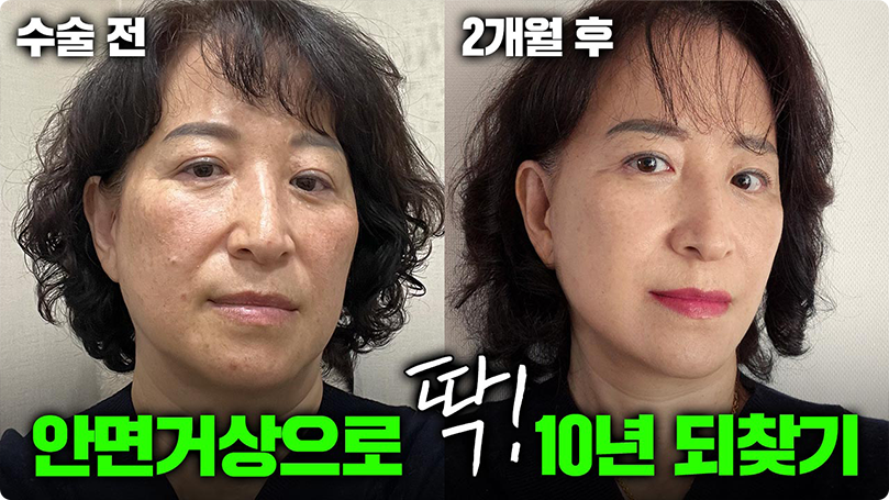 안면거상으로 잃어버렸던 자존감 회복했어요🤗 #안면거상 #리프팅